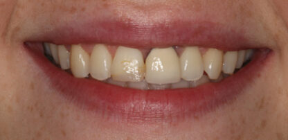 galler before