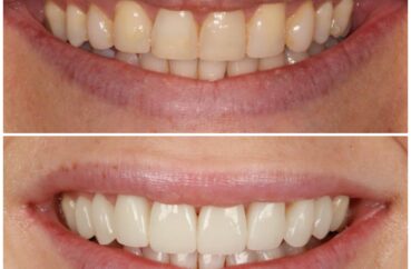 veneers composite bonding