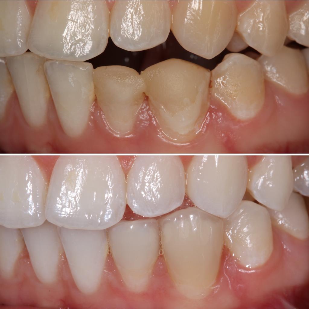 composite veneers