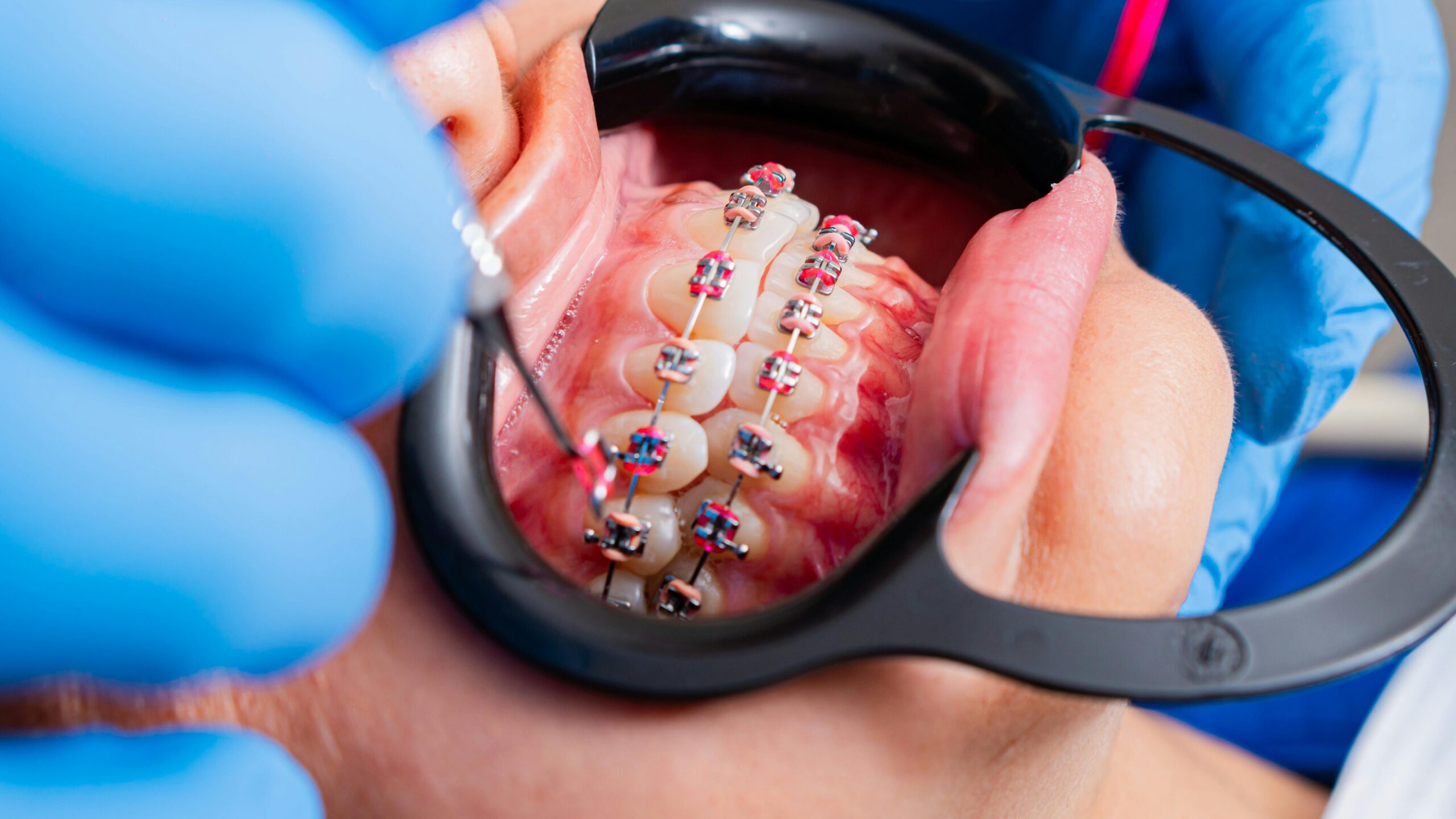 traditional braces