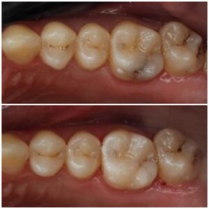 tooth decay toothache