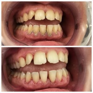 before an after, busting myths about dental hygienists